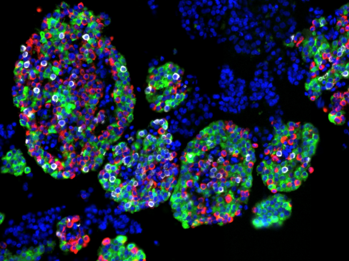 Immunofluorescence image of the pancreatic islets of a 50-year-old female without diabetes. This individual had 54% beta cells (green), 9% delta cells (white) and 37% alpha cells (red)